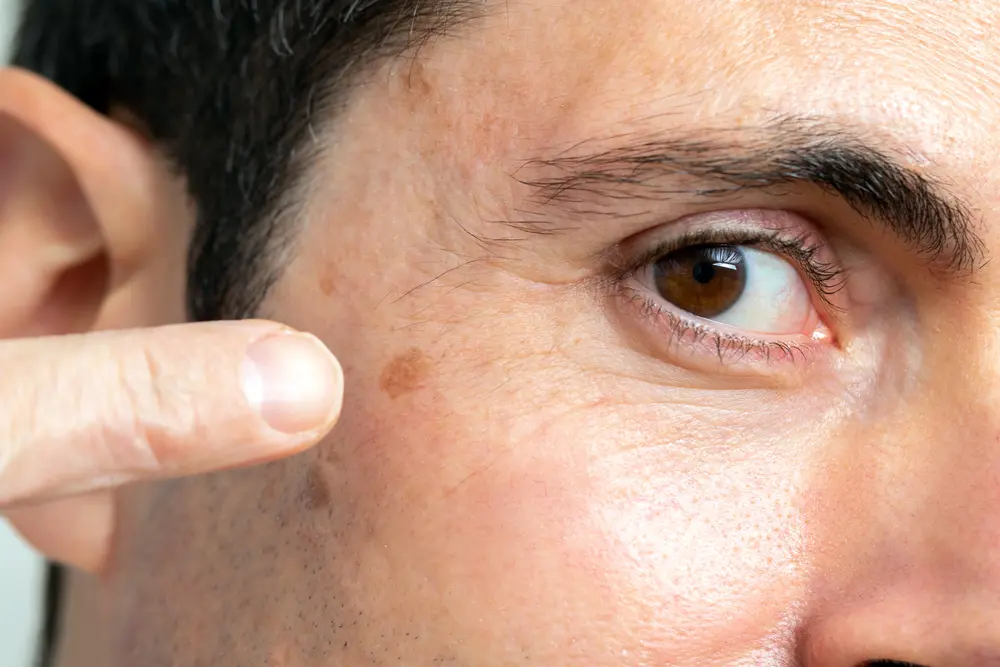 Example of basal cell carcinoma showing characteristic pearly appearance